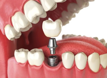 Dental Implant