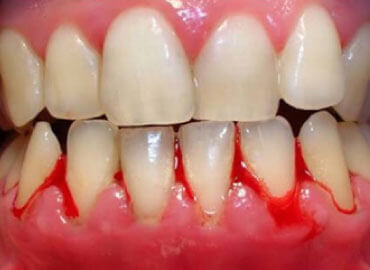 Gum Bleeding/Pyorrhoea