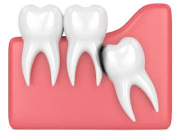 Wisdom Tooth Extraction
