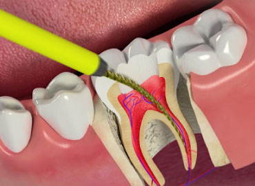 Root Canal Treatment (RCT)
