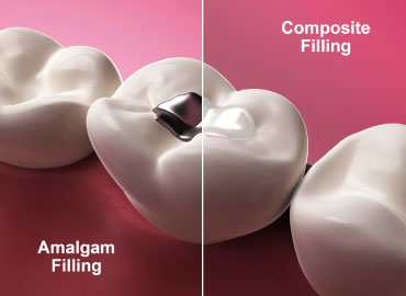 Tooth Coloured Cavity Fillings