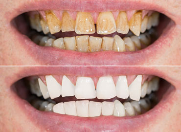 Scaling (Teeth Cleaning)