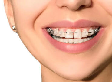 Braces (Orthodontic Treatment)